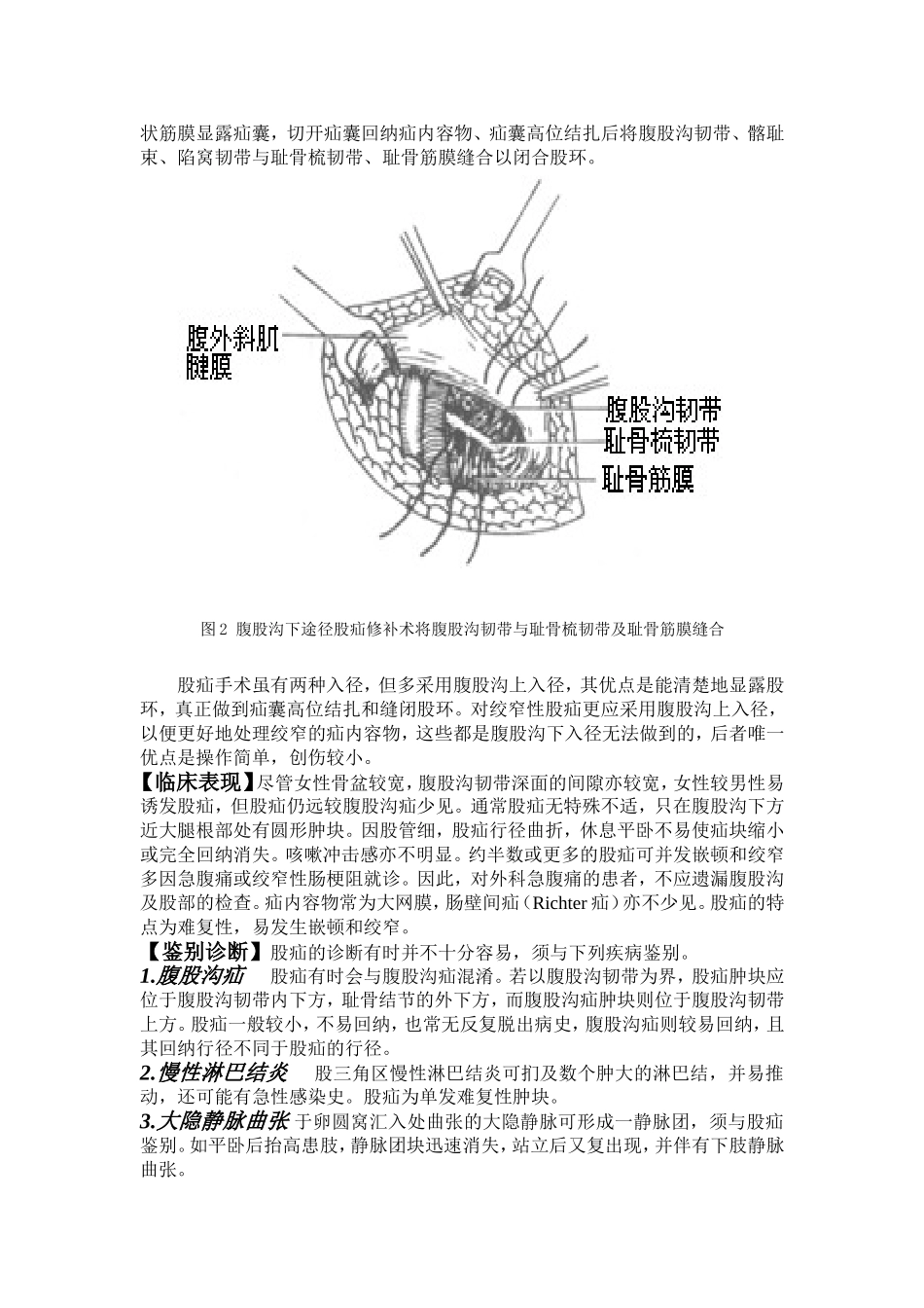 股疝知识讲解_第2页