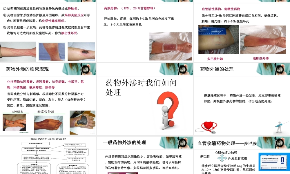 药物外渗的预防与处理