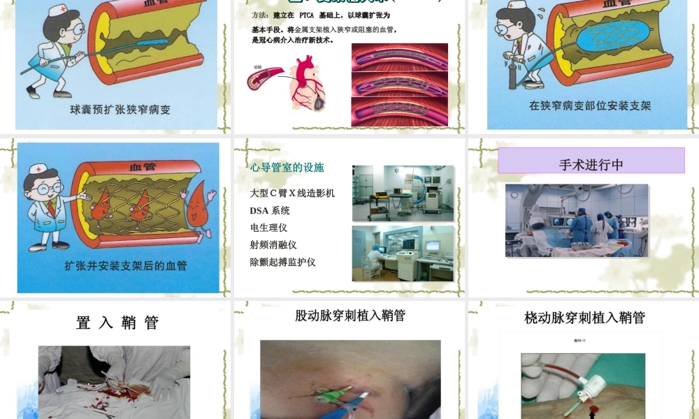 张晶---PCI术的护理查房