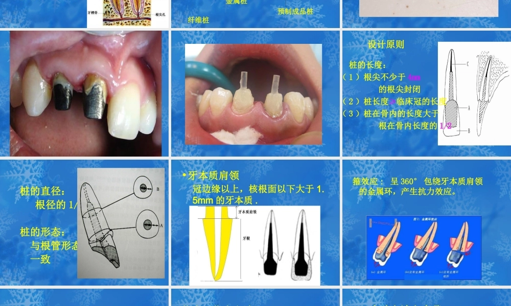 桩核冠修复后导致根折的影响因素