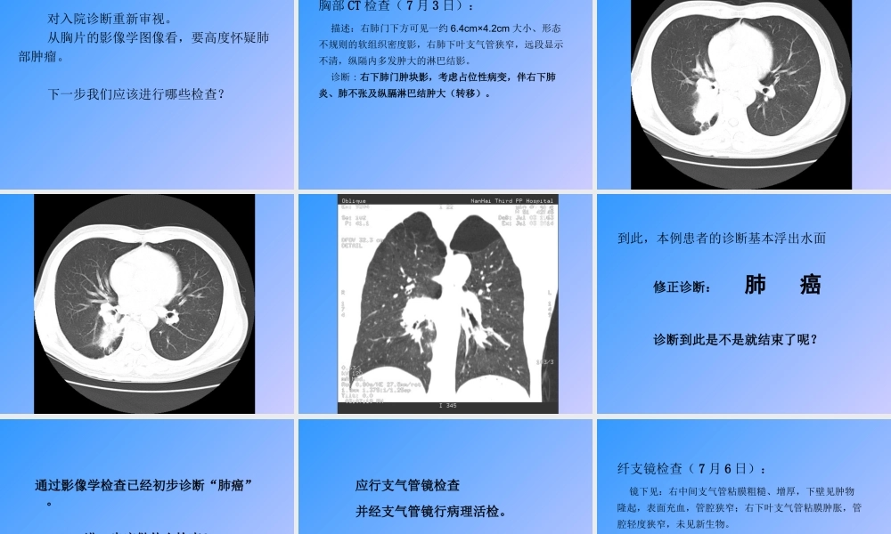肺癌(教学查房)