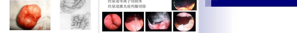 前列腺增生教学查房
