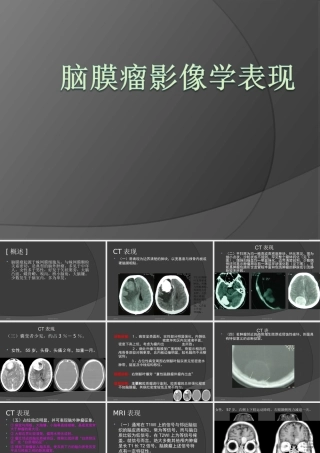 脑膜瘤影像学表现