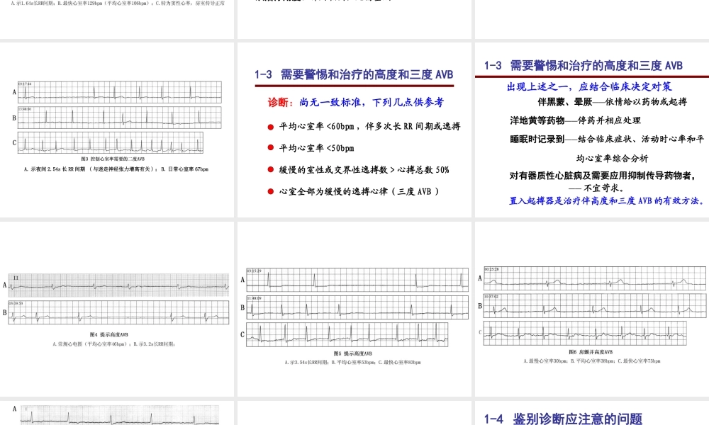 心房颤动心电图诊断难点
