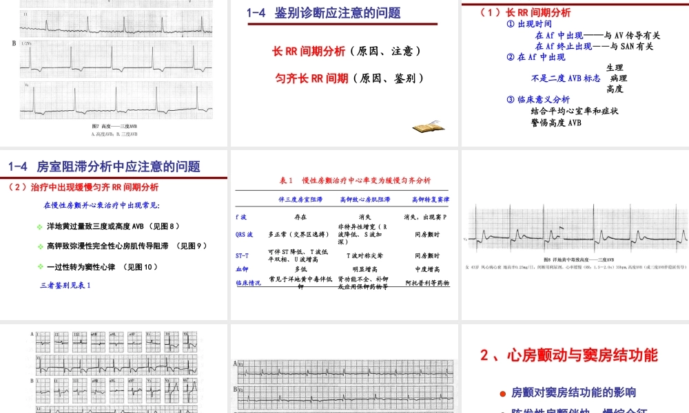 心房颤动心电图诊断难点