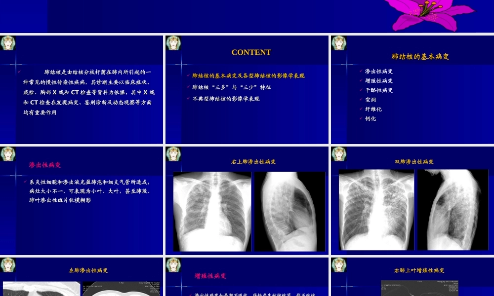 肺结核的影像学诊断