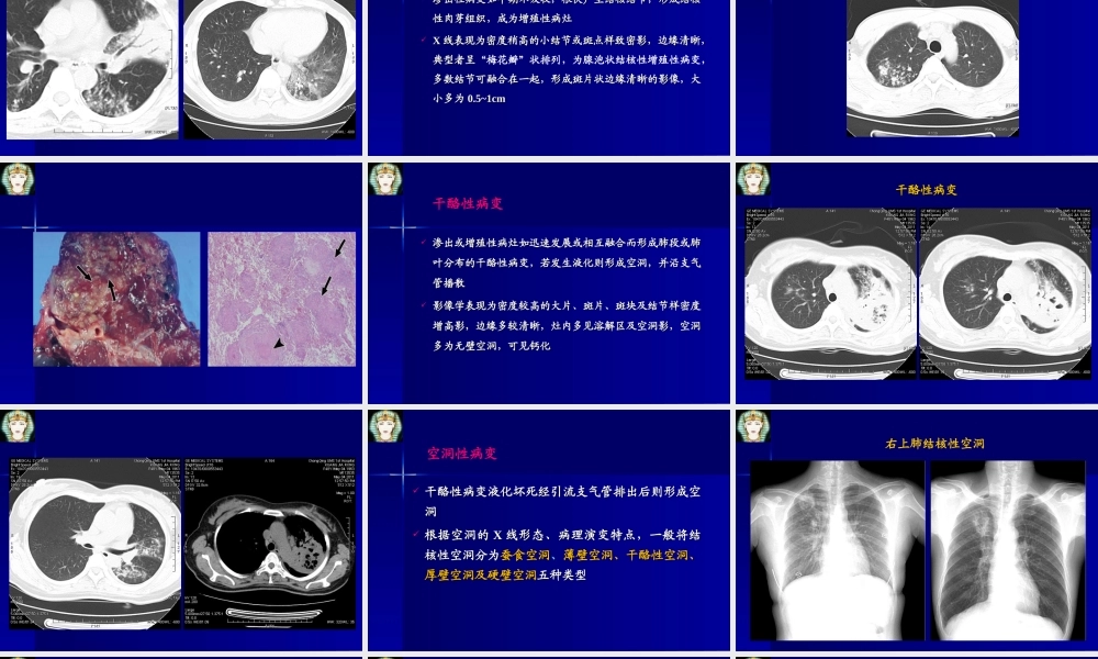 肺结核的影像学诊断
