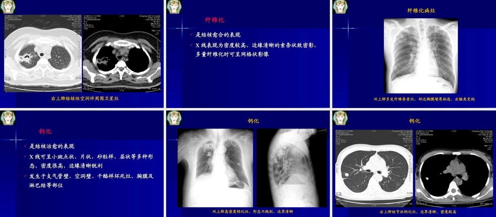 肺结核的影像学诊断