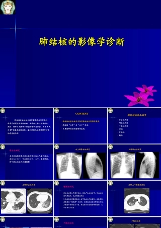 肺结核的影像学诊断