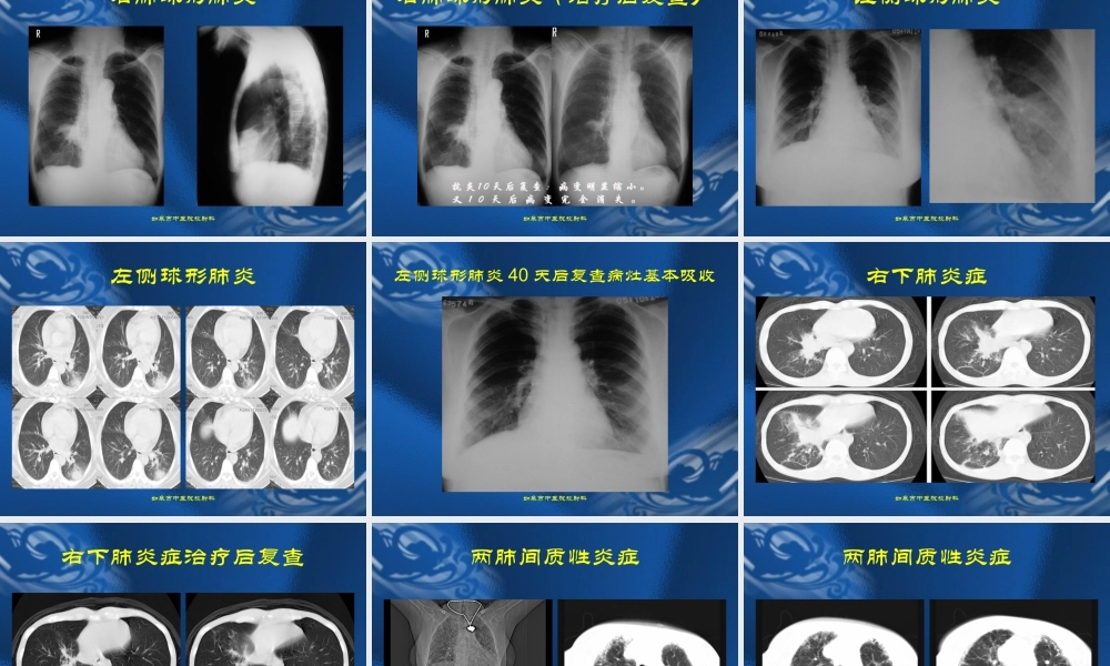 肺炎及肺结核的影像表现