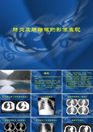 肺炎及肺结核的影像表现