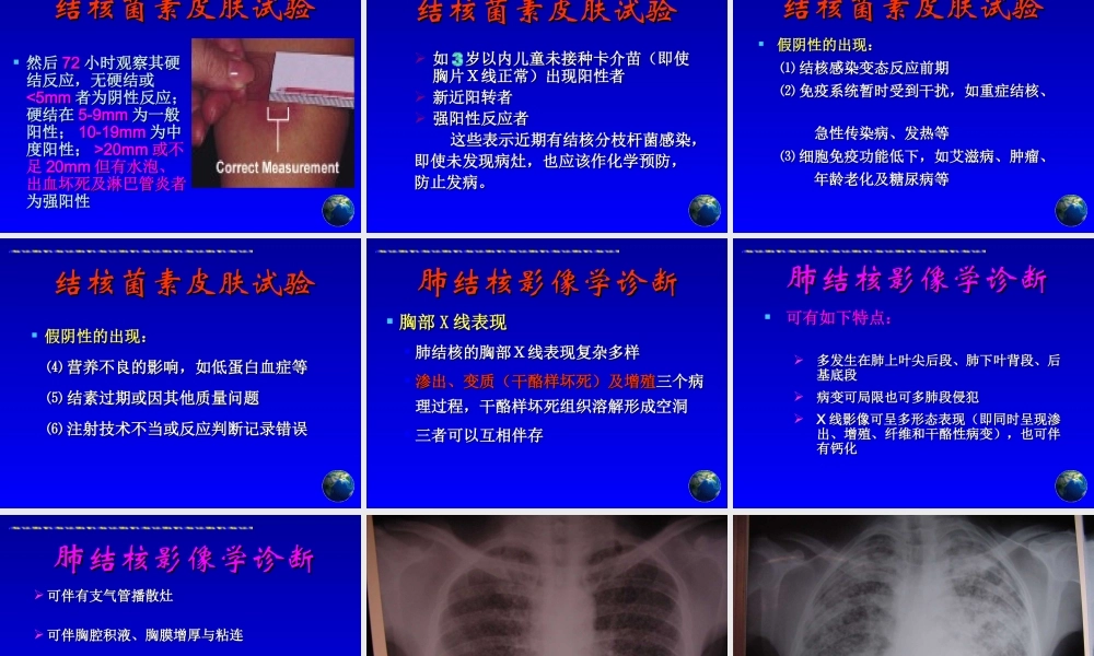 肺结核诊断和治疗进展