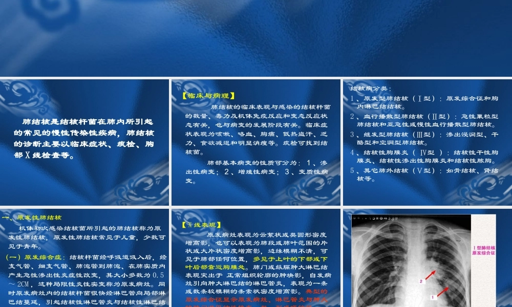 肺结核课件完整