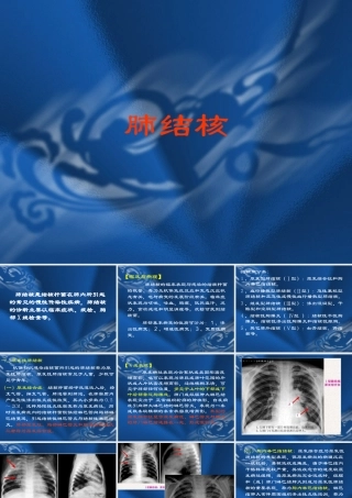 肺结核课件完整