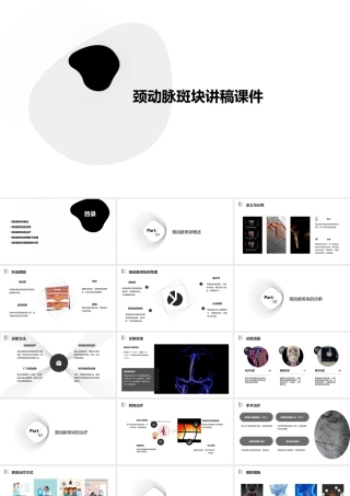 颈动脉斑块讲稿课件
