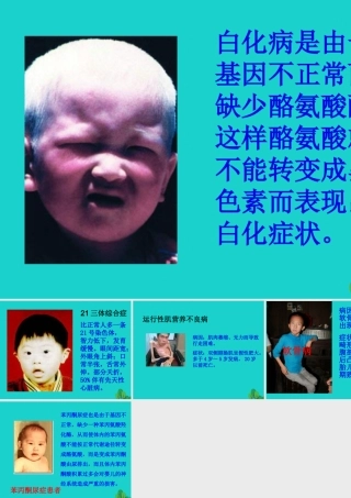 八年级生物上册 第四单元 第四章 第五节 人类优生与基因组计划 常见的遗传病课件 (新版)济南版 课件