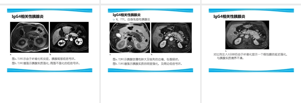 IgG4有关性疾病昀影像体现