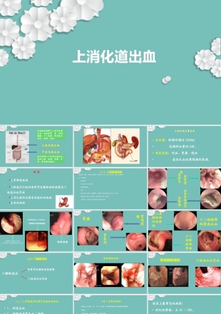 上消化道出血课件