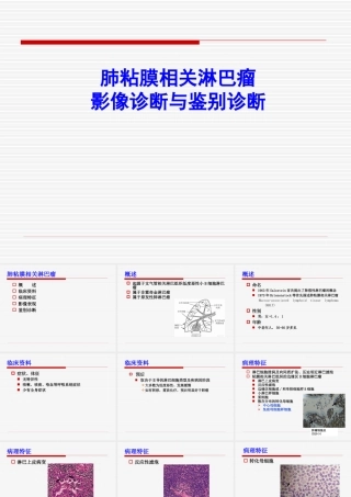 肺MALT淋巴瘤课件