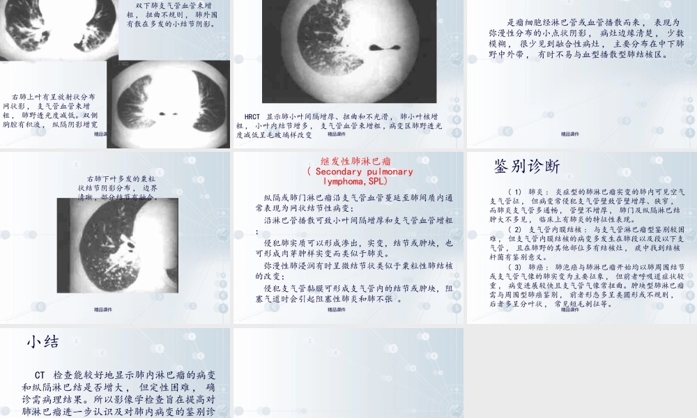 肺淋巴瘤课件