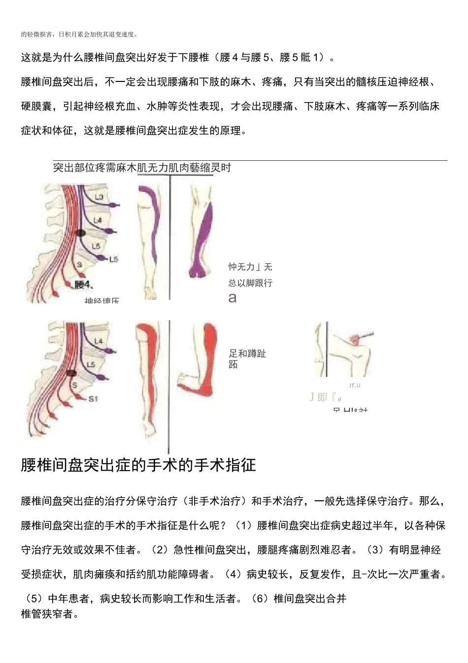 腰椎间盘突出_第2页