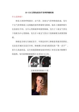 DC-CIK生物免疫治疗各种肿瘤疾病