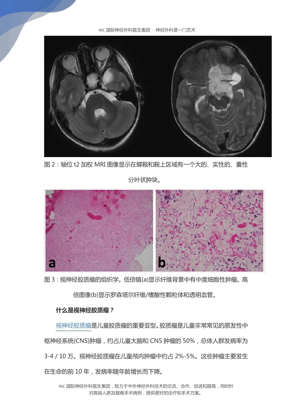 儿童视神经胶质瘤手术和治疗策略_第2页