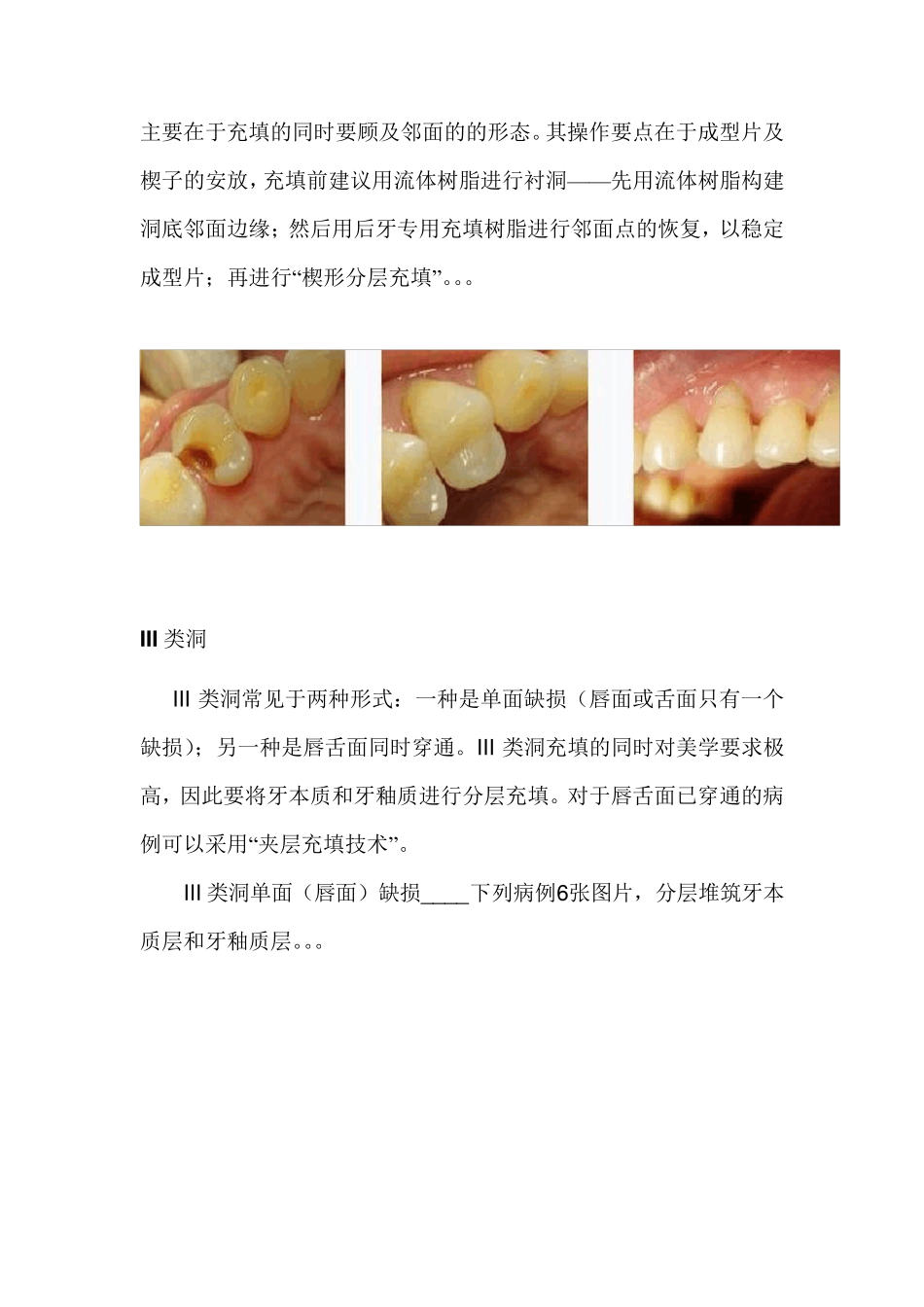 图解各类洞形树脂充填方法_第3页
