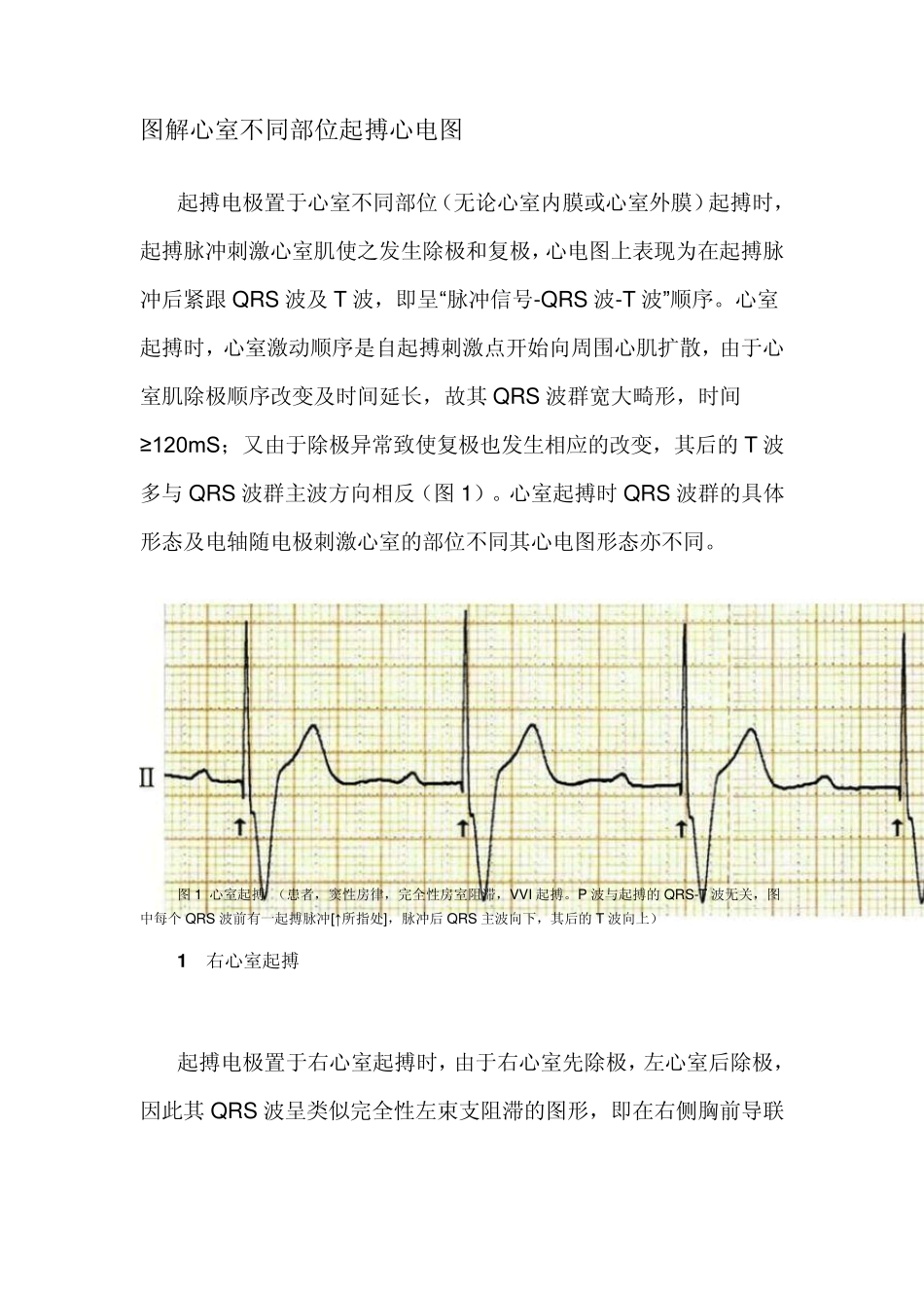 图解心室不同部位起搏心电图_第1页