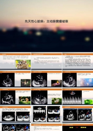 主动脉窦瘤破裂