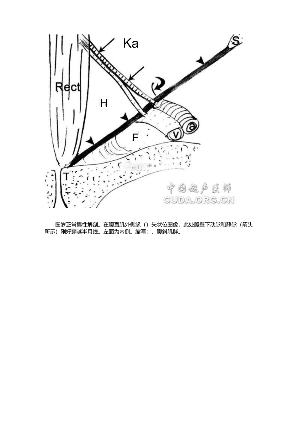 腹股沟疝超声诊断_第2页