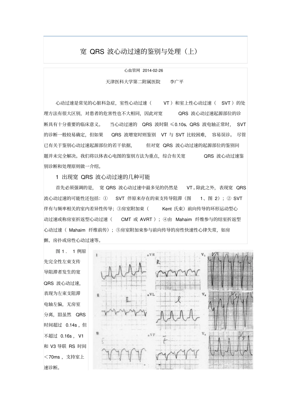 宽QRS波心动过速的鉴别与处理上_第1页