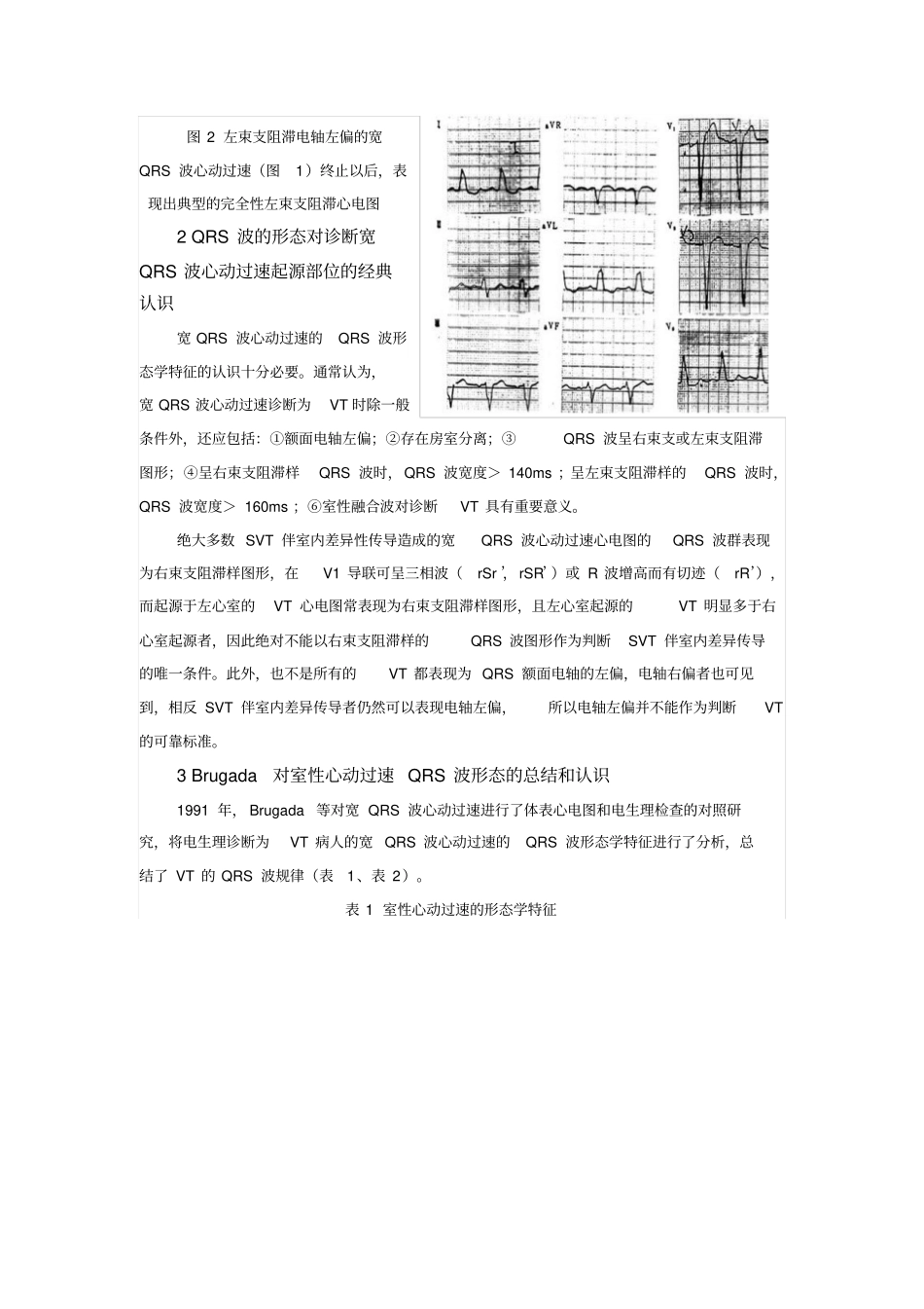 宽QRS波心动过速的鉴别与处理上_第2页