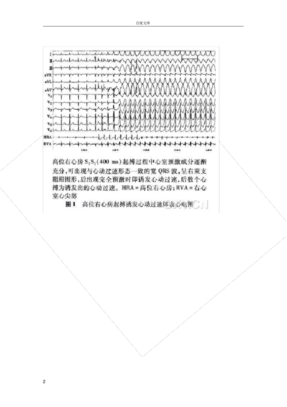 射频消融具有Mahaim纤维特性左侧旁路三例_第2页