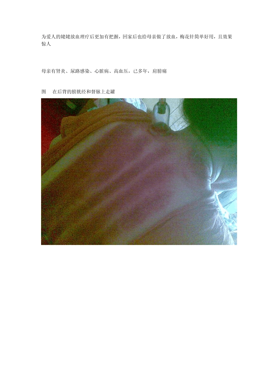 为母亲做放血疗法七星针比三棱针好用_第1页