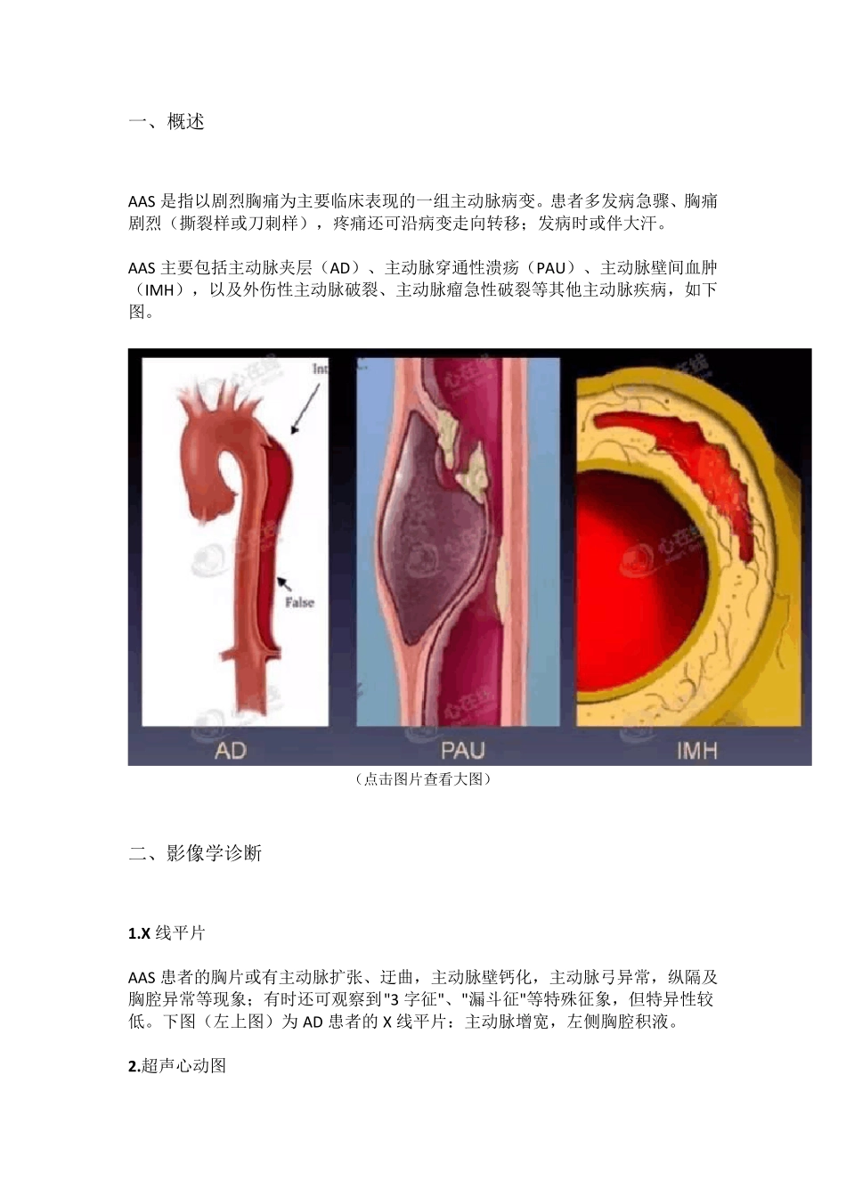 主动脉夹层的影像诊断_第1页
