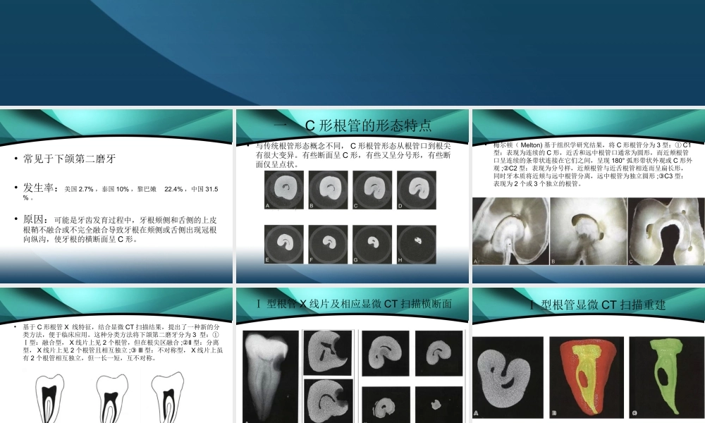 C形根管的分类及治疗