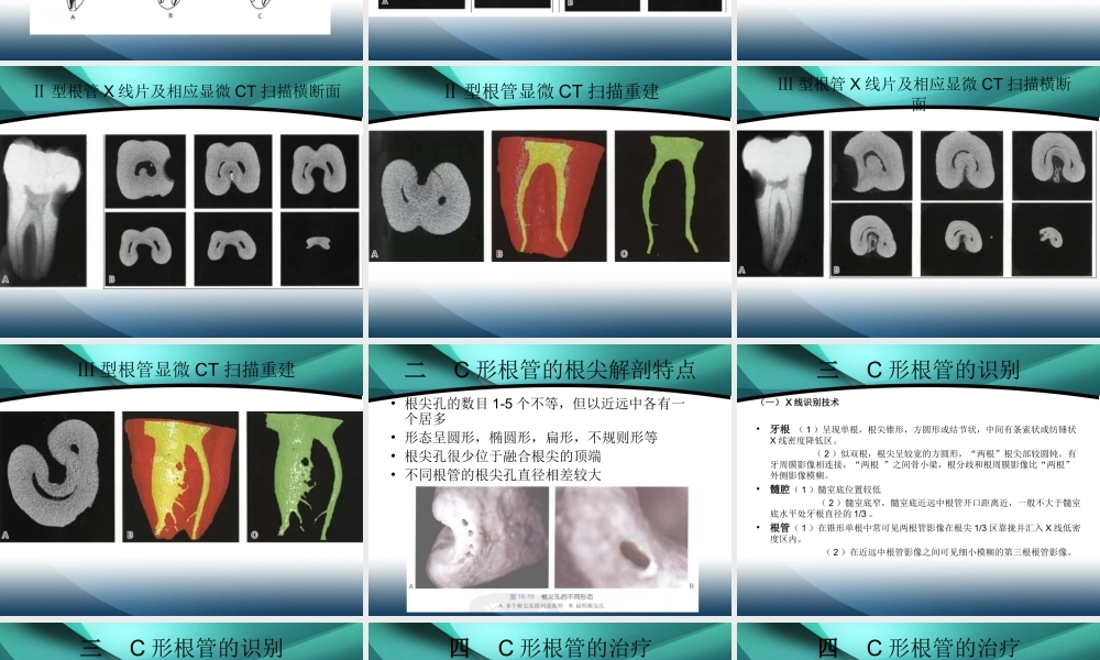 C形根管的分类及治疗
