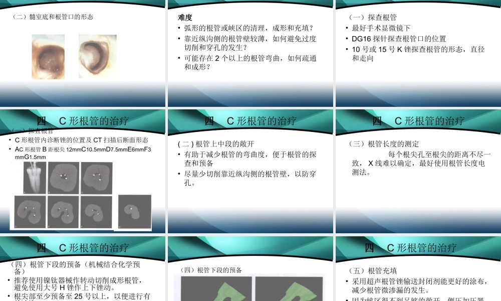 C形根管的分类及治疗