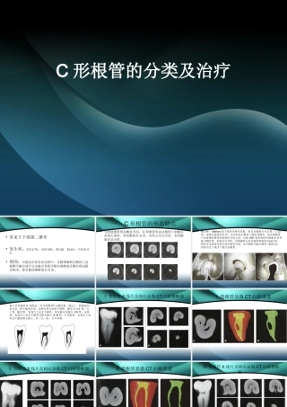 C形根管的分类及治疗