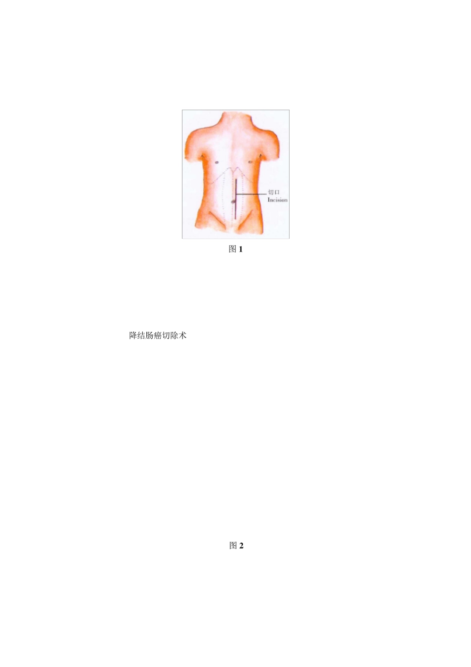左半结肠切除术_第3页