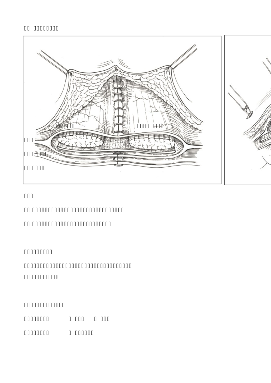 巴德腹壁切口疝手术开放术式_第2页