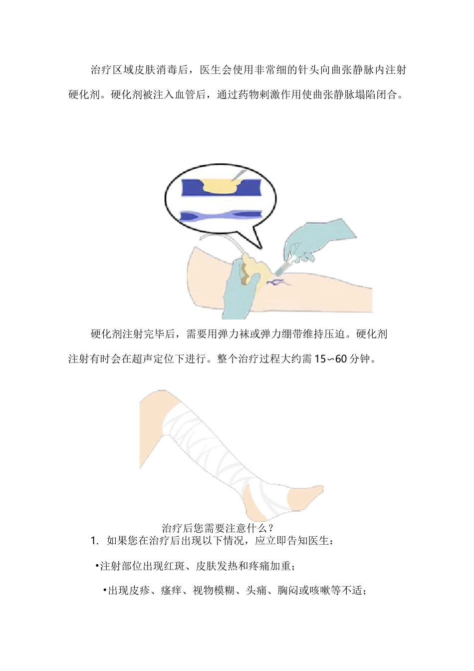 硬化剂注射治疗下肢静脉曲张_第3页