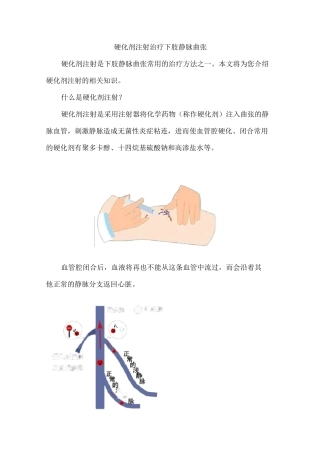 硬化剂注射治疗下肢静脉曲张