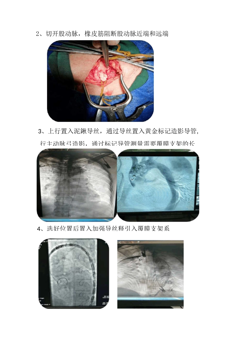 主动脉夹层腔内隔绝术护理配合指引_第3页