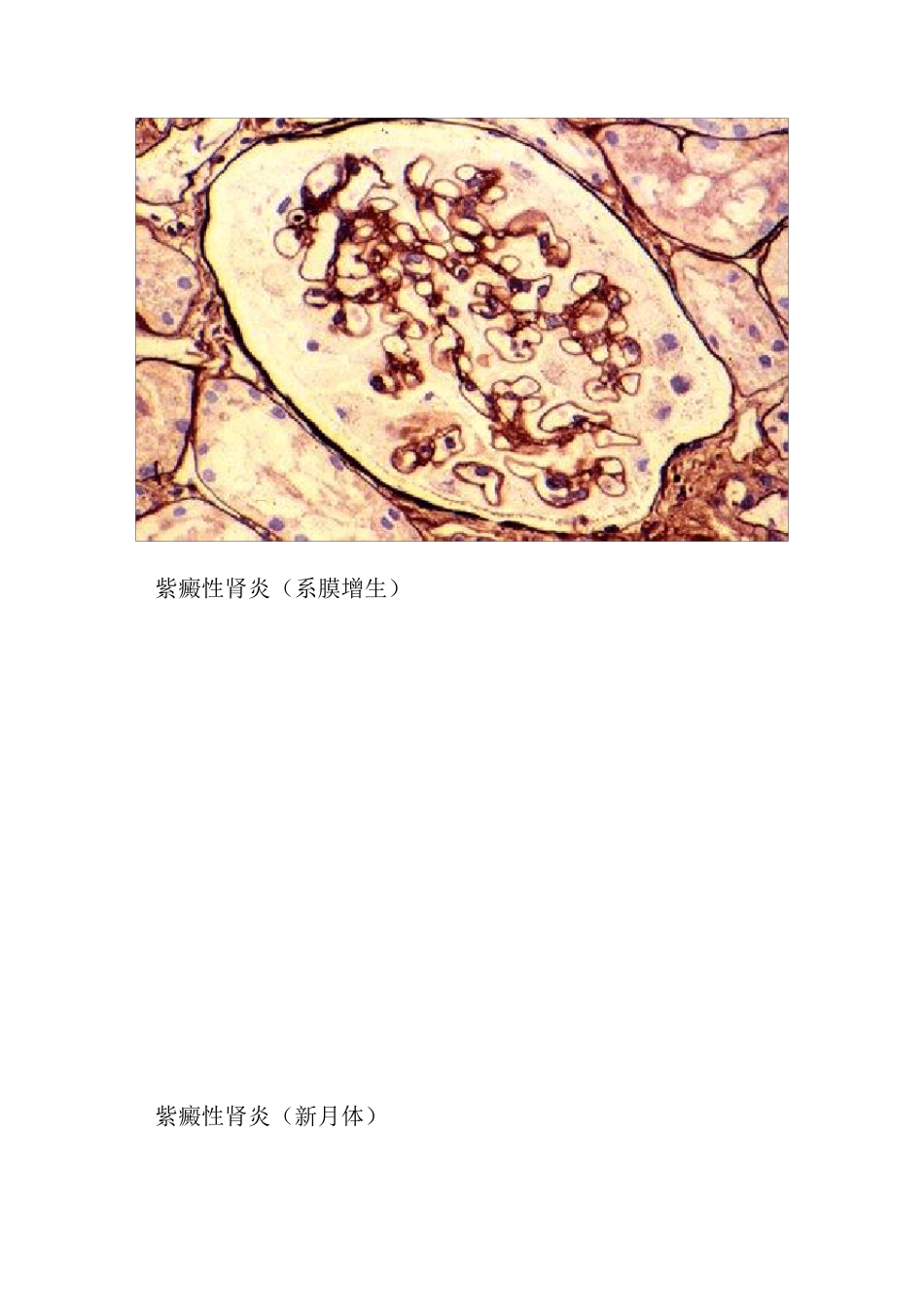 19.各种肾脏病病理图片_第3页