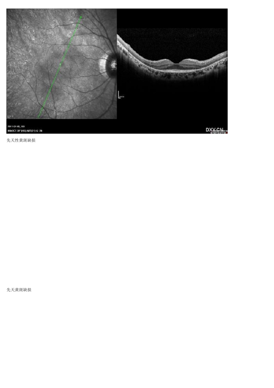 OCT视网膜10层结构讲解_第2页