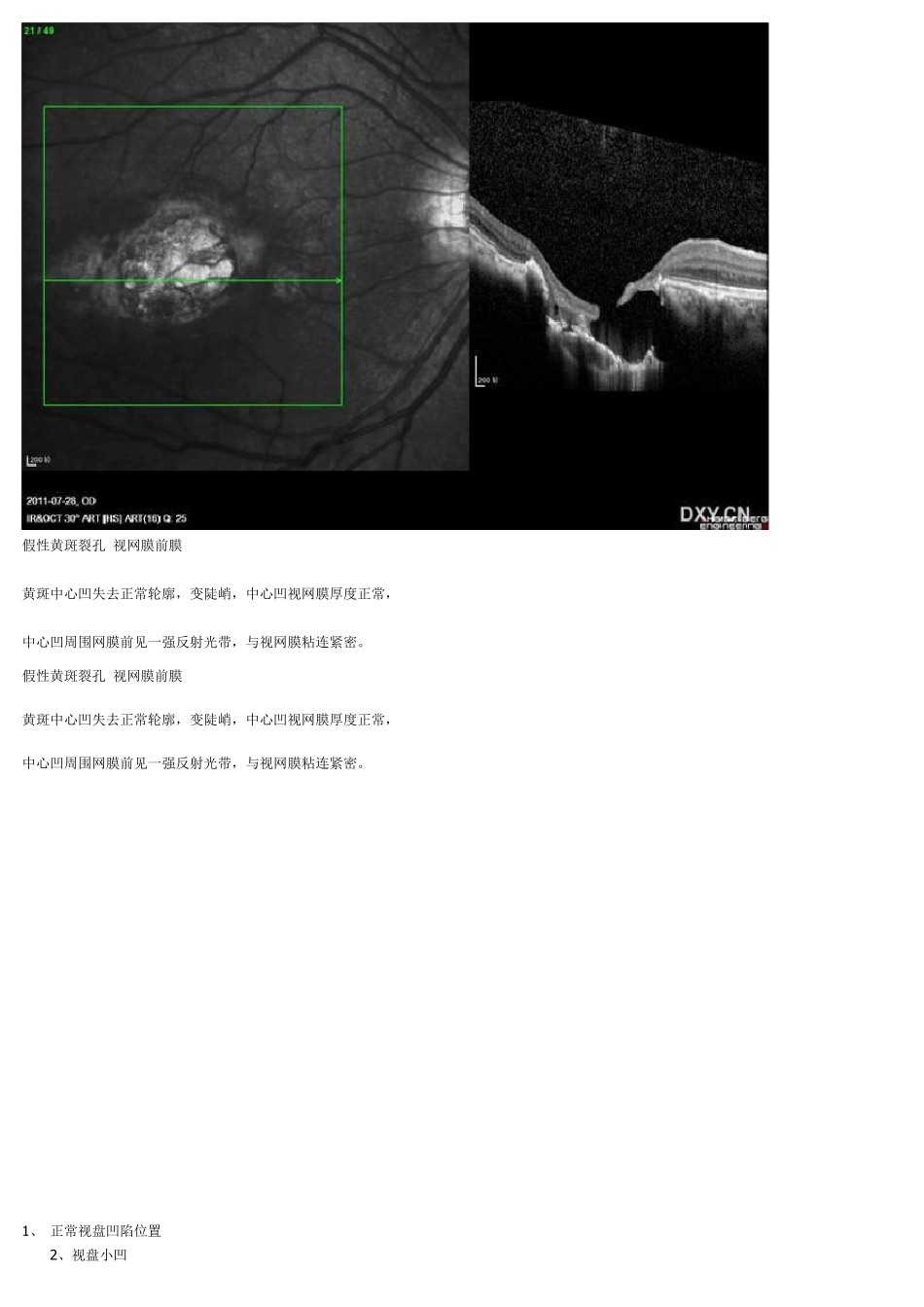 OCT视网膜10层结构讲解_第3页