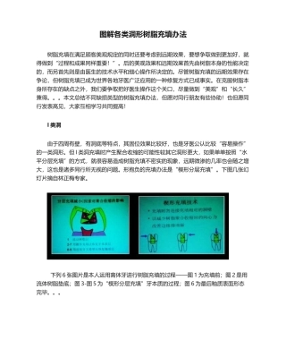 2025年图解各类洞形树脂充填方法