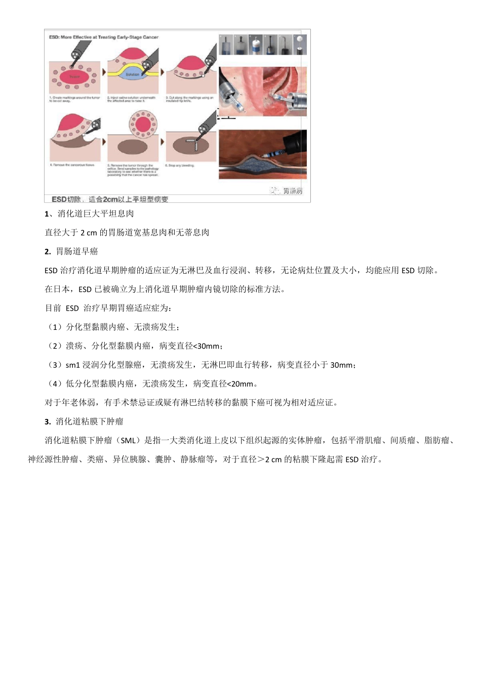 内镜粘膜下剥离术(ESD)_第2页